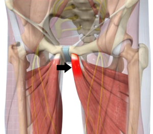 Adductor Tendinopathy