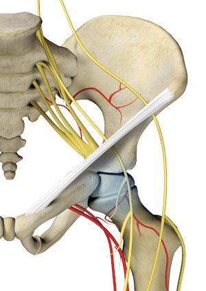 Avascular Necrosis of the Hip