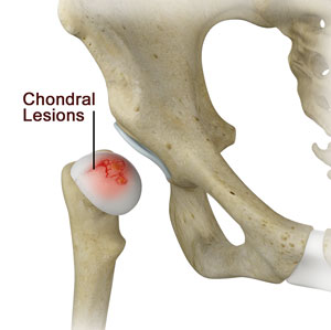 Chondral Lesions