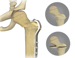 Derotational Osteotomy