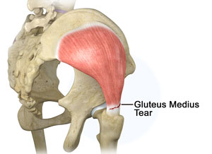 Gluteus Medius Tendon Tear