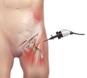 Hip Arthroscopy