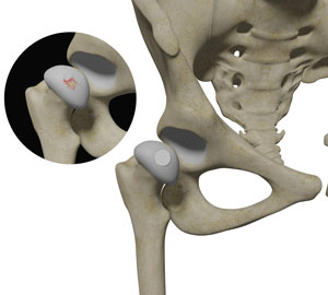 Cartilage Restoration