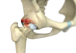 FAI Hip Surgery