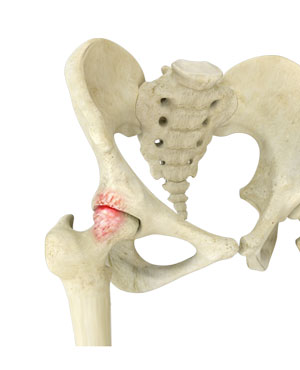 Hip Impingement