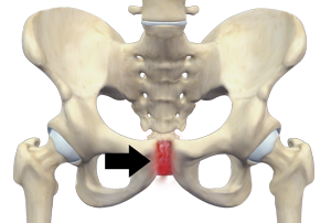 Osteitis Pubis