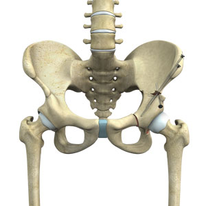 Peri-Acetabular Osteotomy