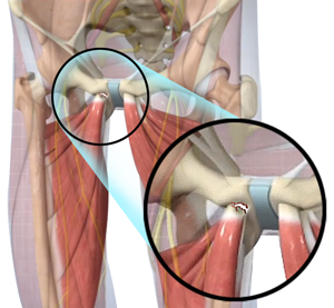 Proximal Adductor Avulsions