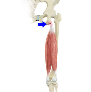 Proximal Hamstring Injury