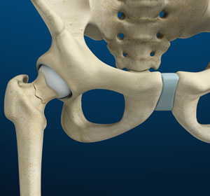 Hip Stress Fractures