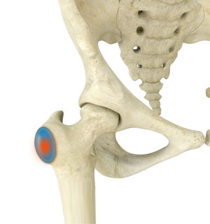 Trochanteric Bursitis