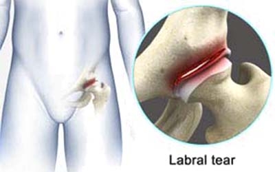 Hip Labral Tear NYC