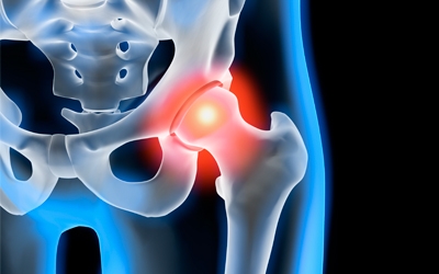 Signs You Might Have a Labral Tear of the Hip